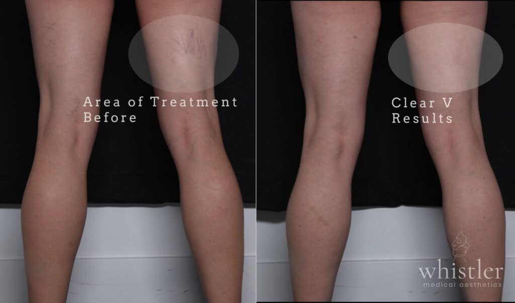 leg veins treated with Clear V