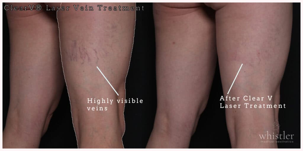 Leg veins treated with Clear V