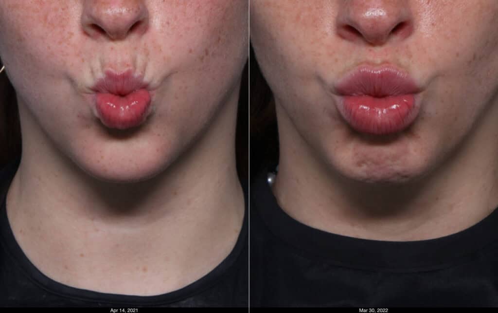 Lip Lines before and after